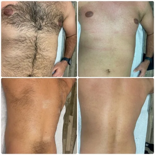 Before and after chest, stomach, and back waxing results for a male client