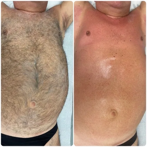 Before and after chest and stomach waxing results for a male client