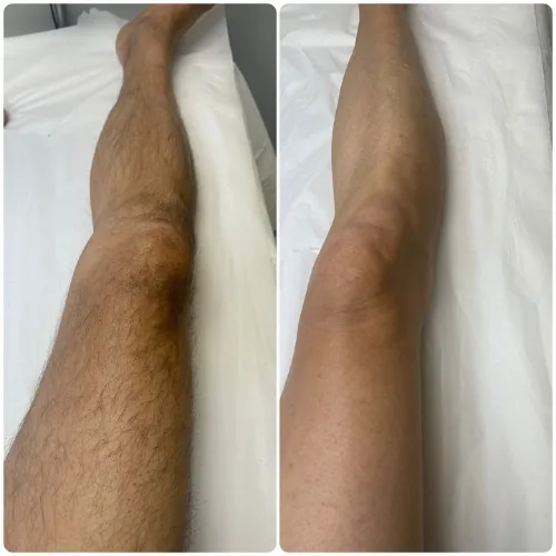 Before and after leg waxing results for a male client