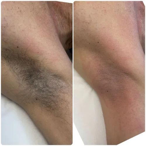 Before and after underarm waxing results for a male client